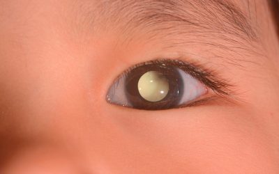 ENFERMEDAD DE COATS: EL DESCONOCIDO ENEMIGO DE LA VISTA