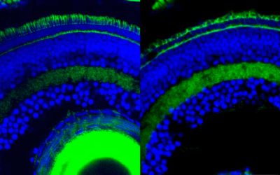 AVANZANDO HACIA EL ESCLARECIMIENTO DE ENFERMEDADES HEREDITARIAS DE LA RETINA DE CAUSA DESCONOCIDA